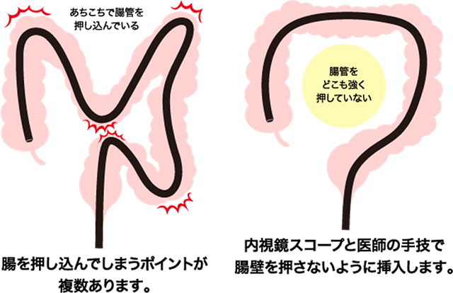 無送気軸保持短縮法