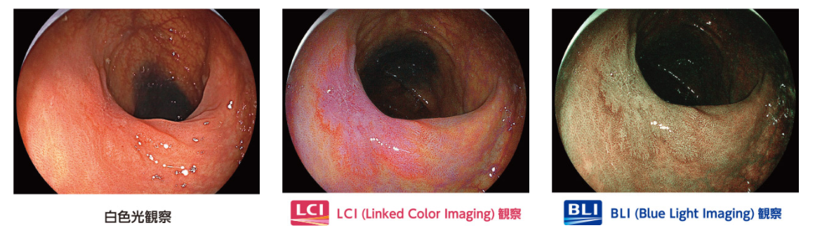 画像強調観察BLI/LCI機能に対応