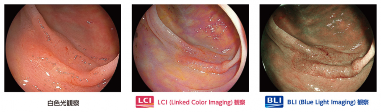 画像強調観察BLI/LCI機能に対応