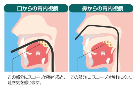 経鼻内視鏡と経口内視鏡を選べます